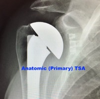 Total Shoulder Replacement, Colorado Springs