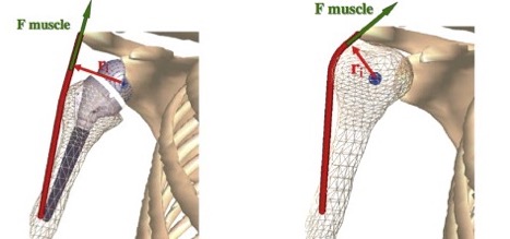 Reverse Total Shoulder Replacement - Dr. Chris Jones Colorado Springs