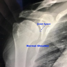 Total Shoulder Replacement