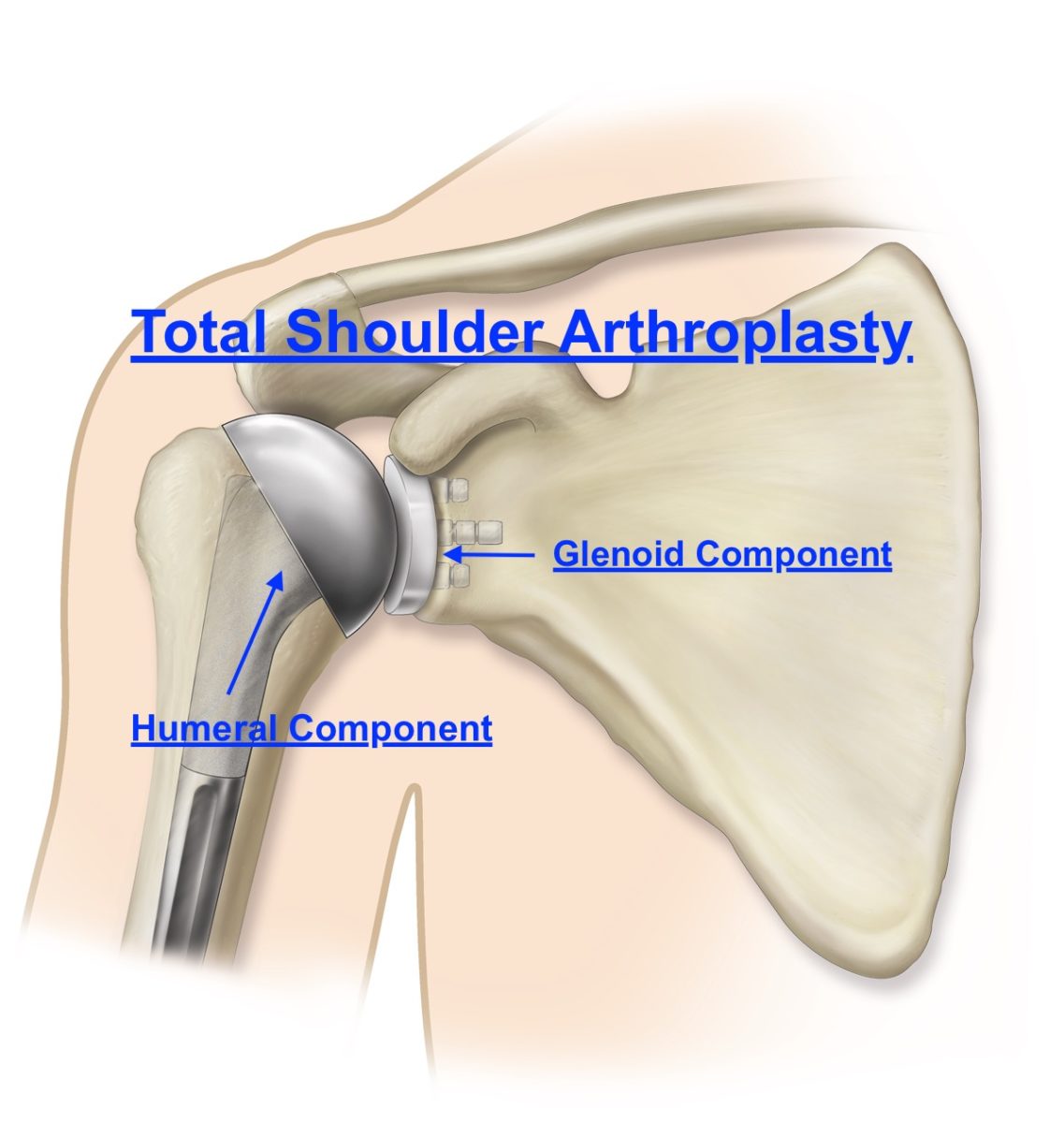 how long does a total shoulder replacement surgery take