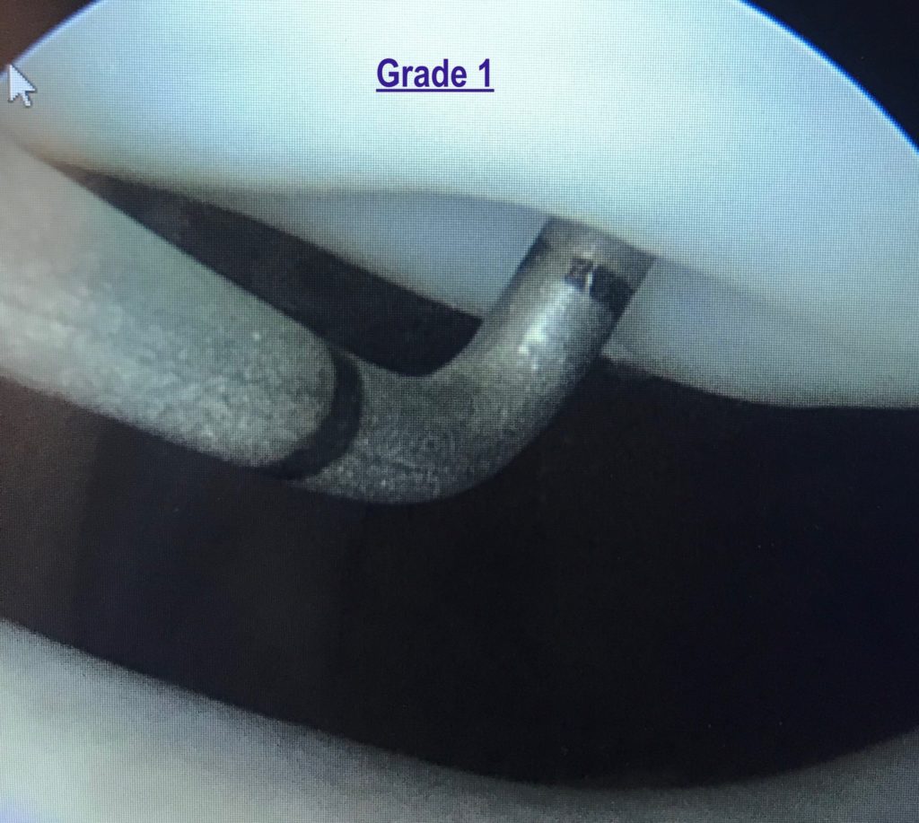 Chondromalacia grade 1
