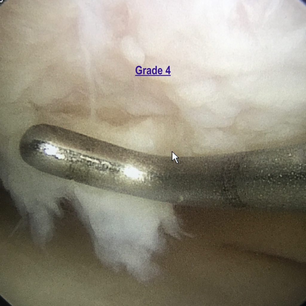 Chondromalacia grade 4
