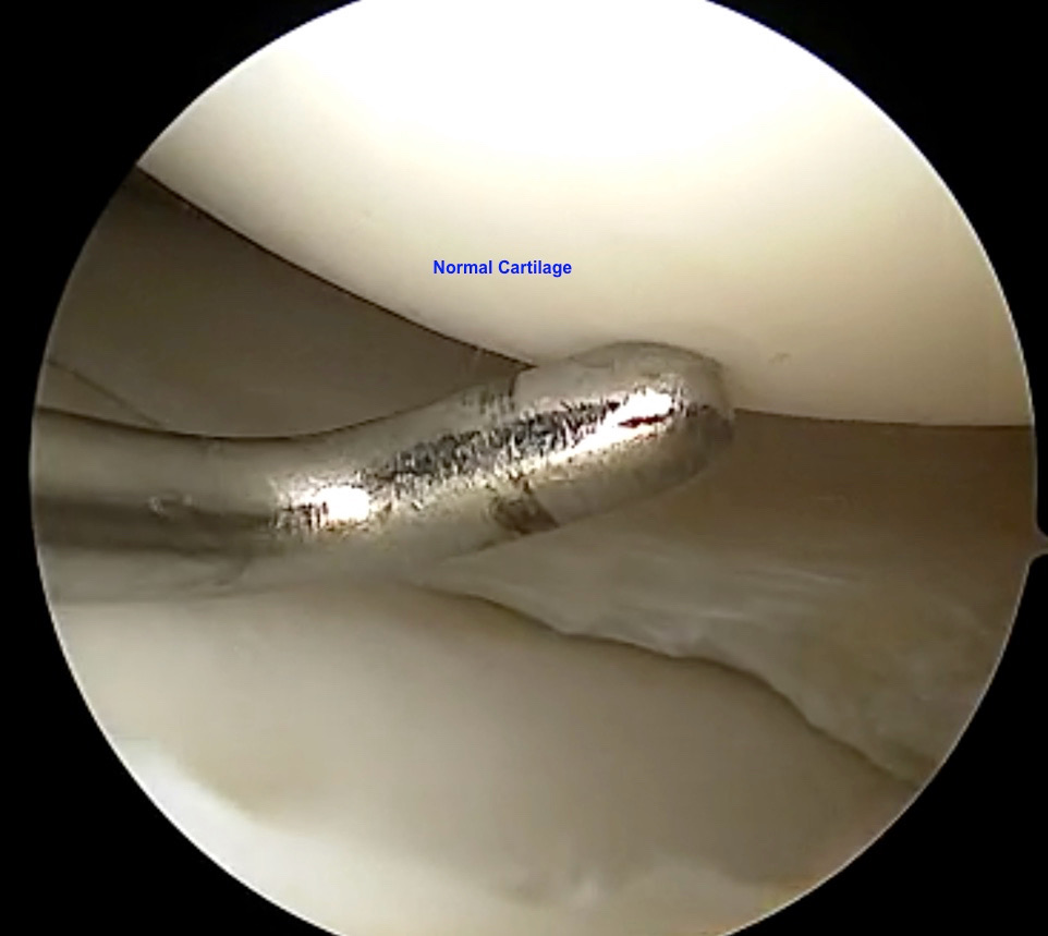 Chondromalacia normal