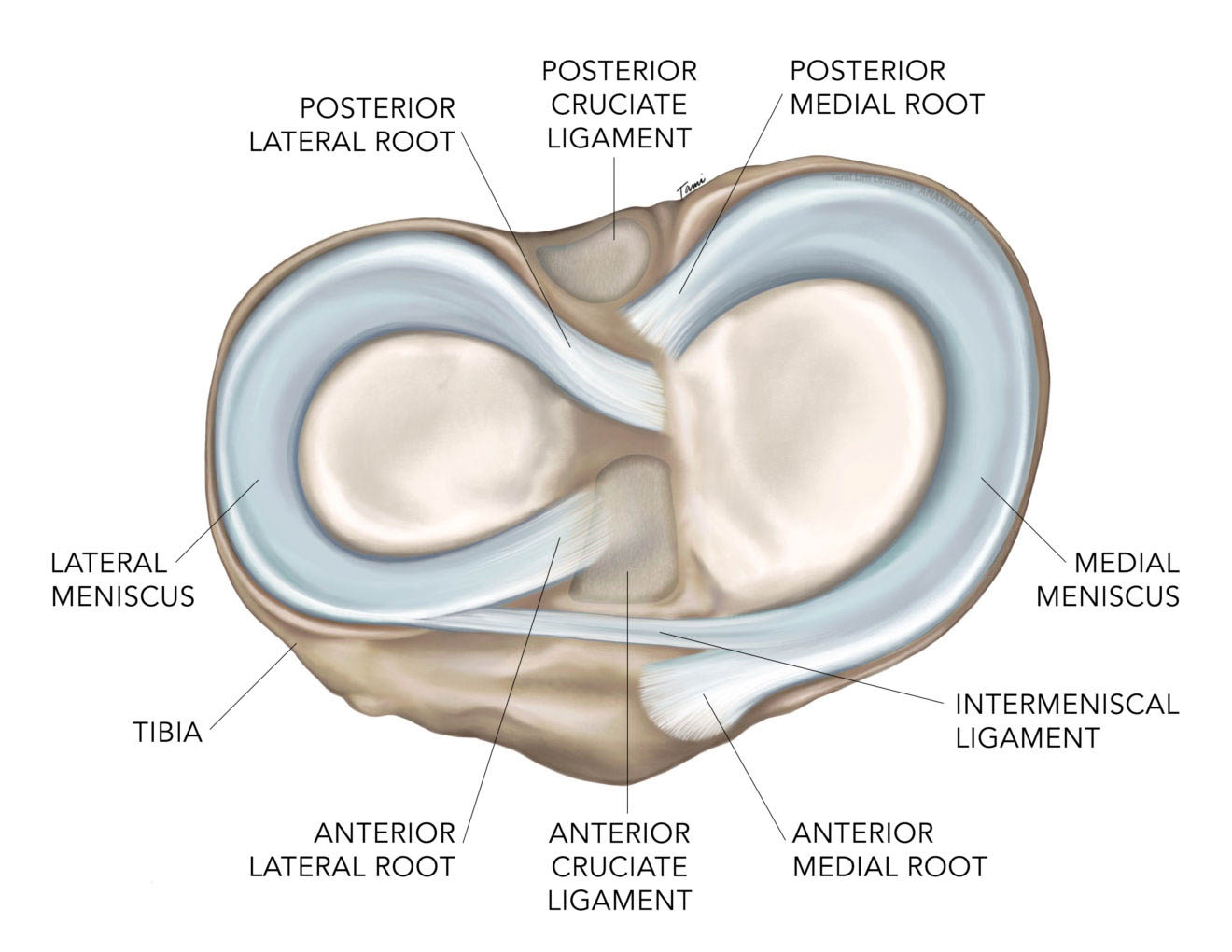 Meniscal Root Tears Dr Chris Jones Colorado Springs Co