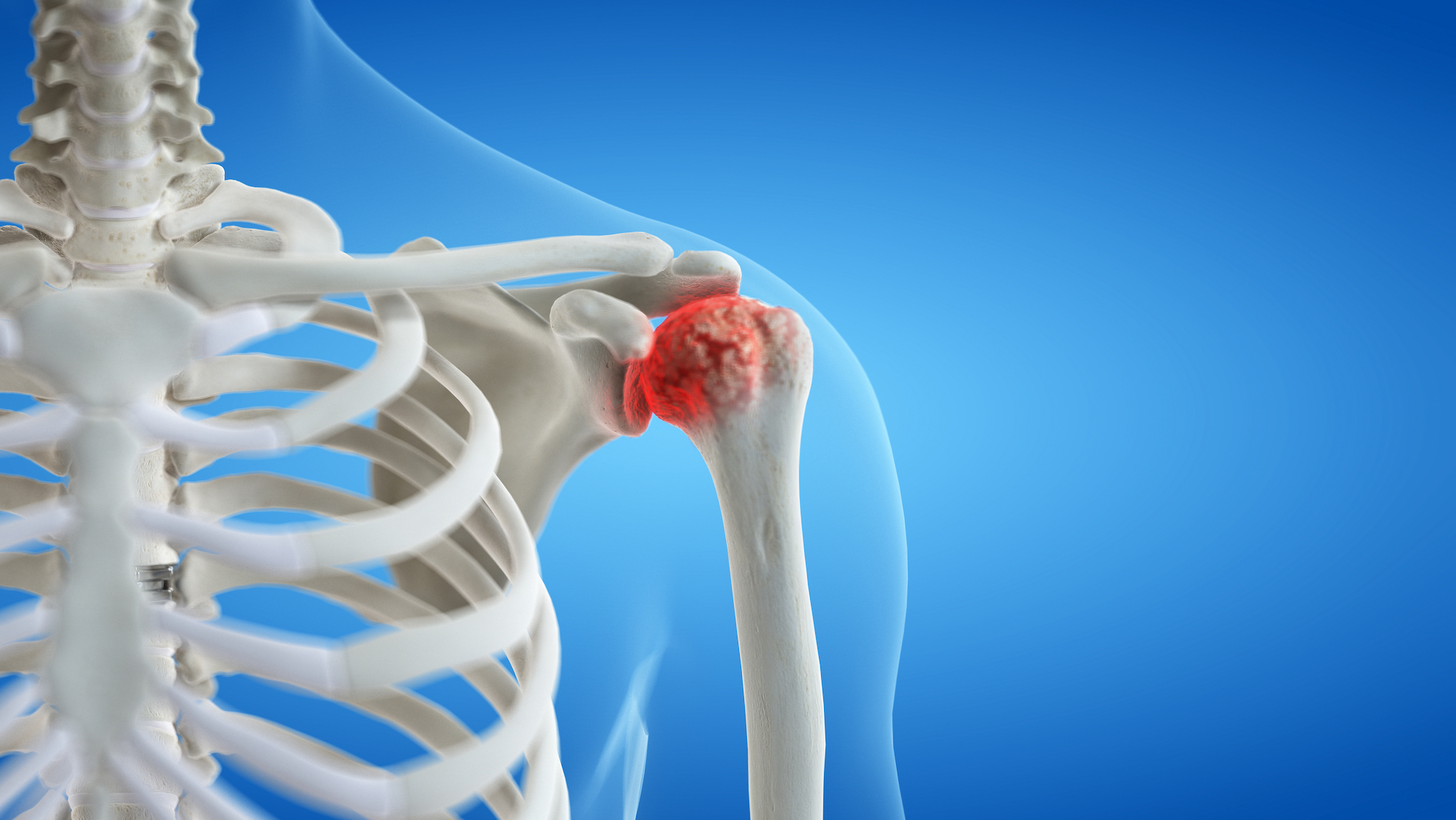 Shoulder Arthritis Surgery