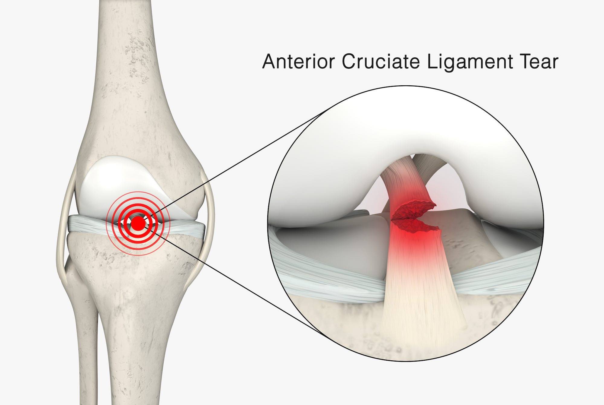 ACL Tear Surgery & Information  Colorado Springs Sports Doctor