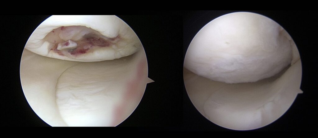 Arthroscopic view of ACI before and after