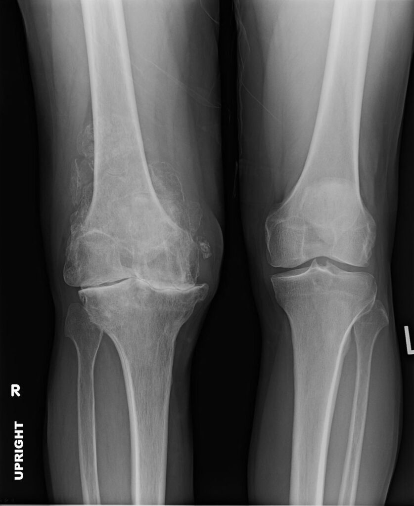 X-ray of patient requiring knee cartilage restoration