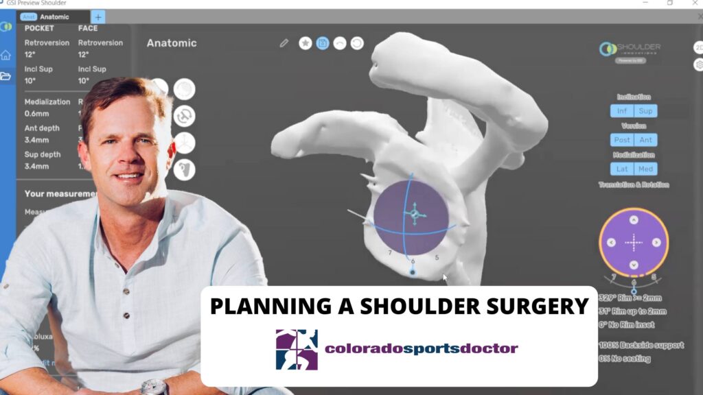 Dr. Chris Jones uses surgical planning software for shoulder replacement surgery