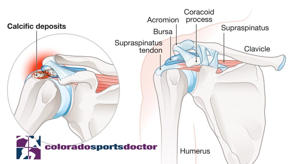 Shoulder anatomy and Calcific Tendonitis