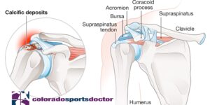 Shoulder anatomy and Calcific Tendonitis