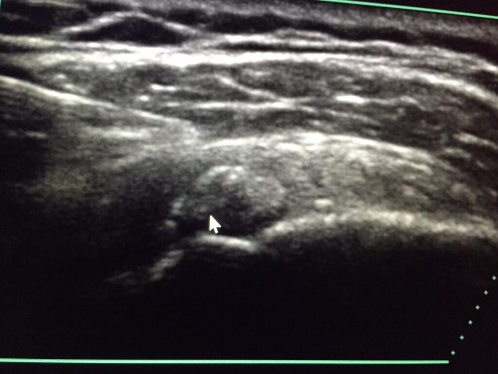Ultrasound showing calcific tendonitis