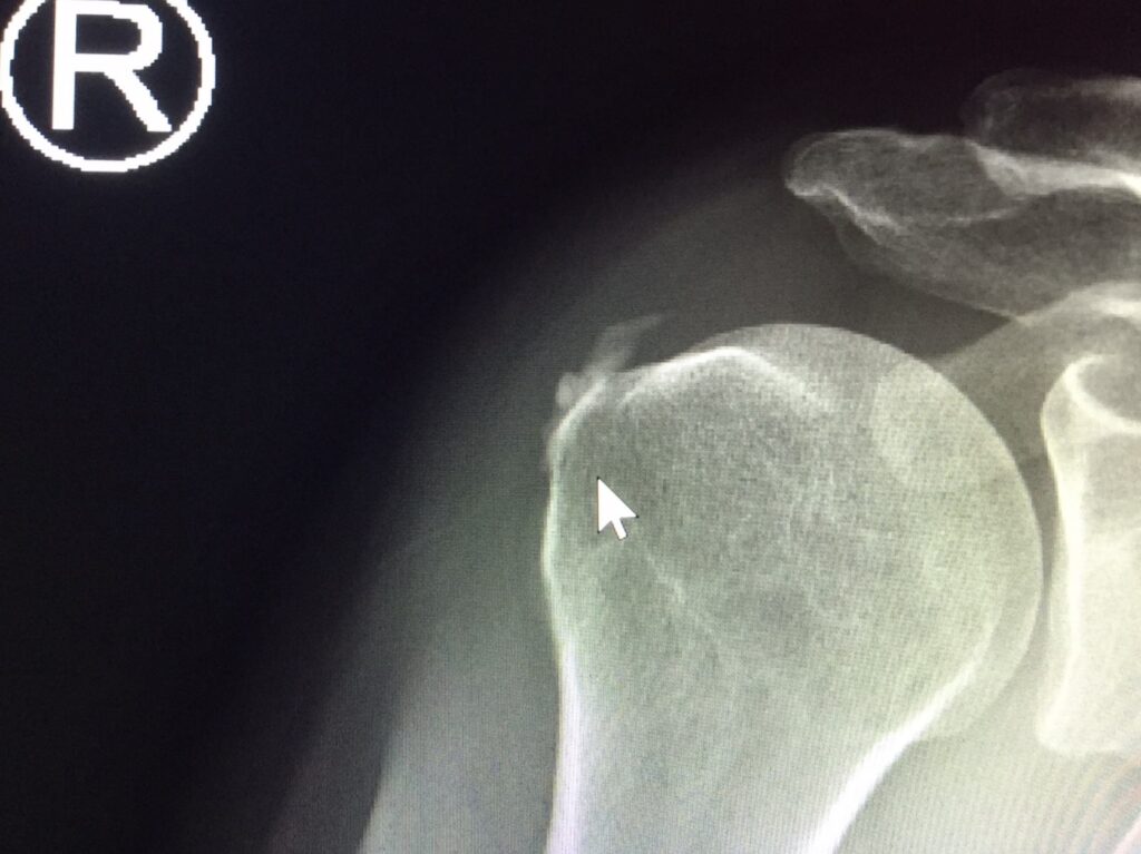 Calcific Tendonitis as indicated by calcium deposit within the rotator cuff