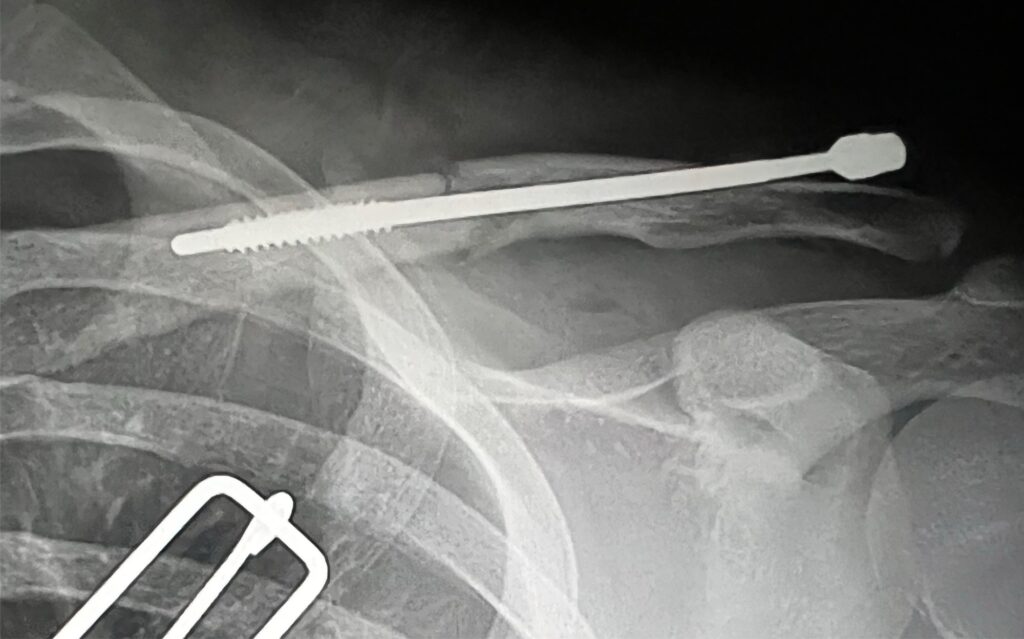 IM fixation of clavicle fracture from mountain bike accident