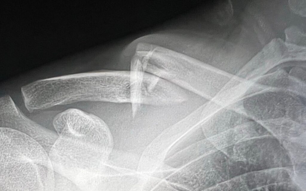 Clavicle fracture from mountain bike accident