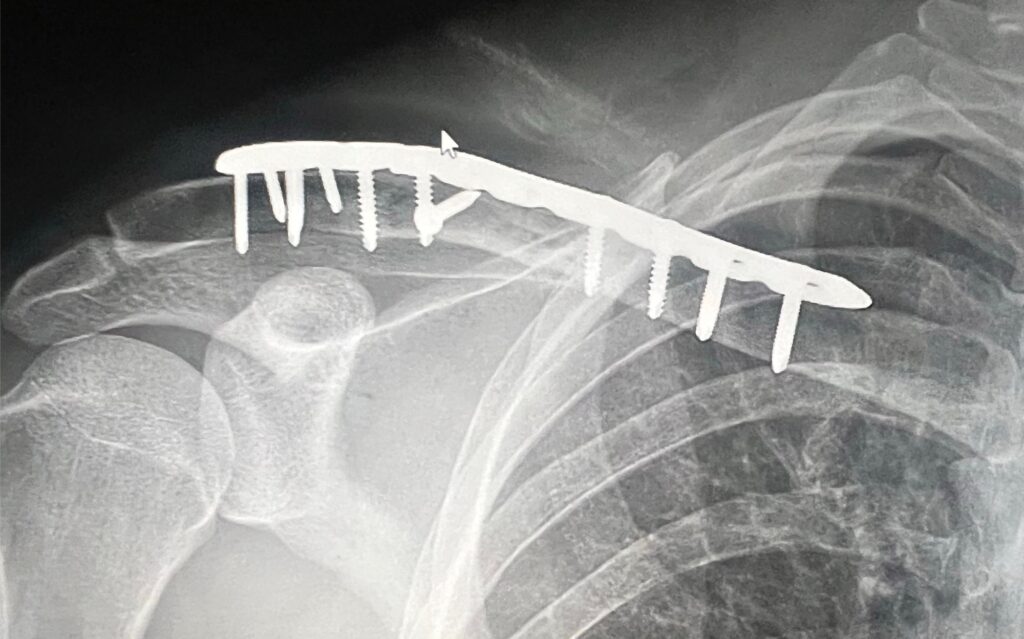 Plate fixation of clavicle fracture from mountain bike accident