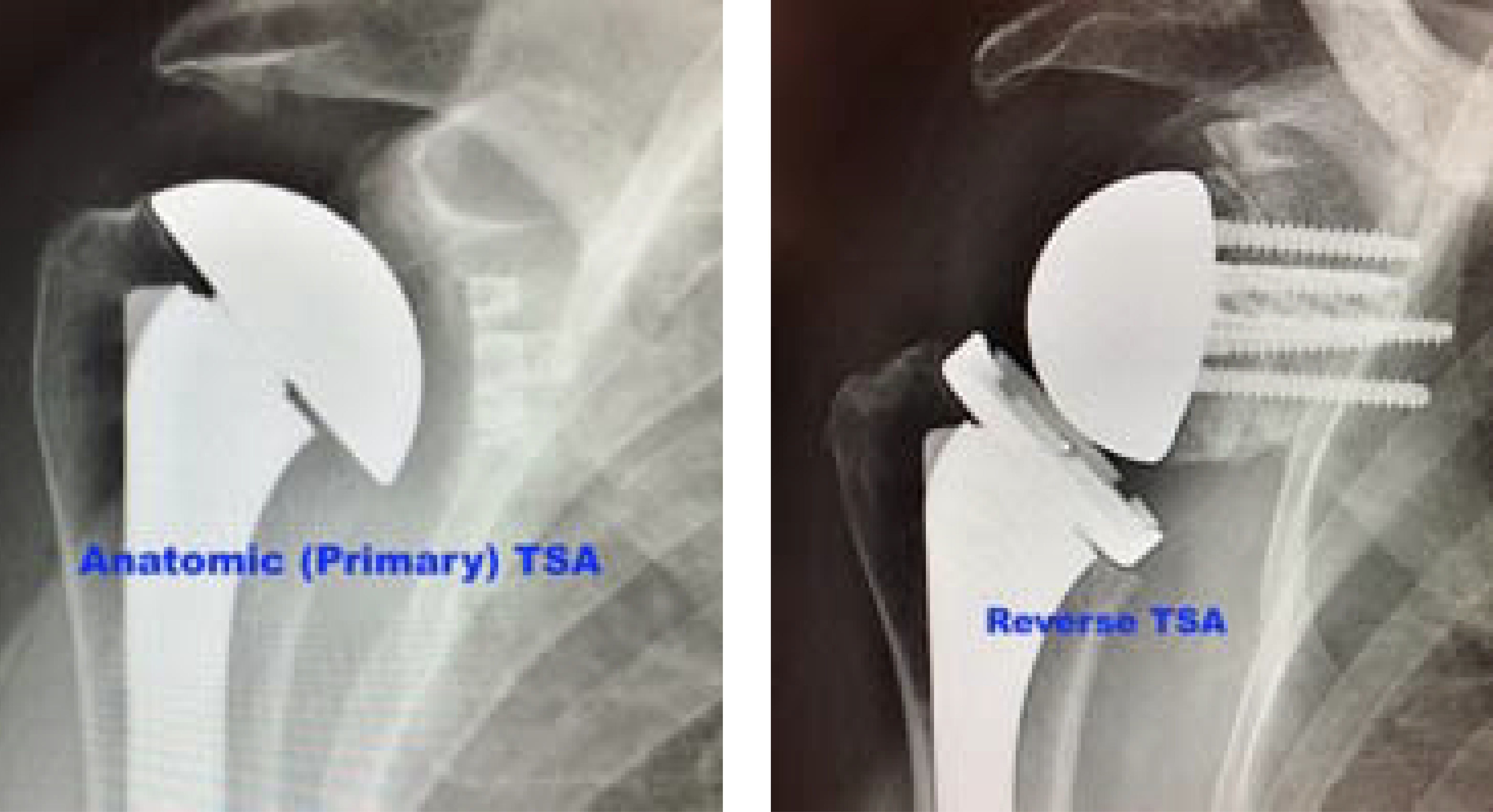 Primary vs. Reverse Total Shoulder Replacement