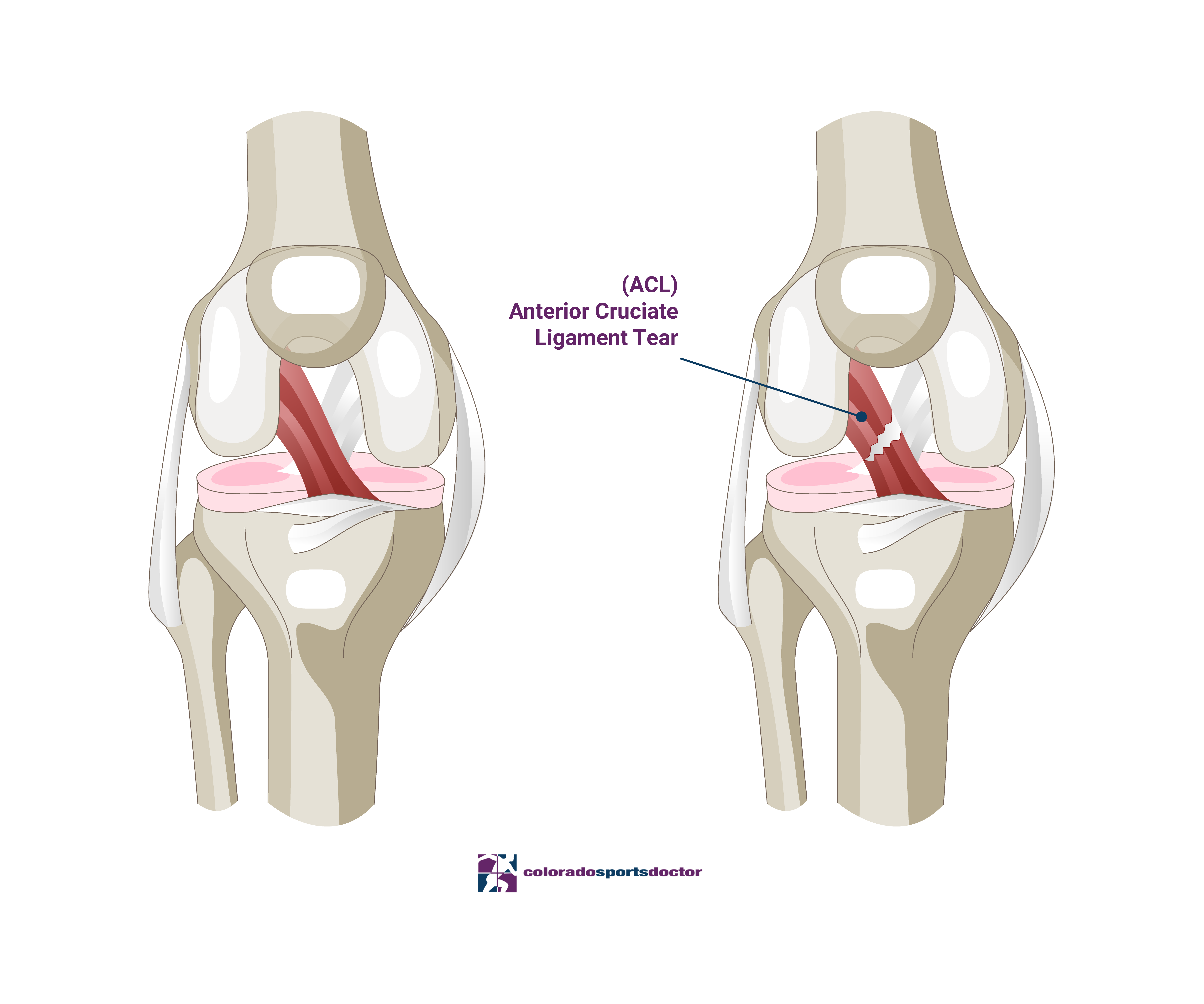 ACL TEAR