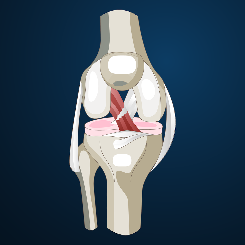 Anterior Cruciate Ligament (ACL) tear anatomy | Contact Dr. Chris Jones for an appointment today