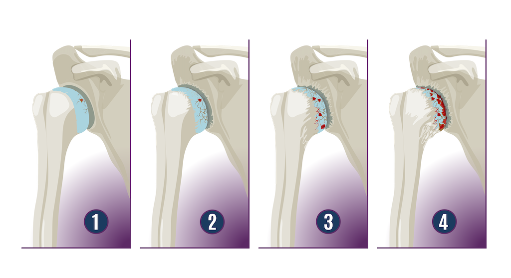 Chris Jones Arthritis Graphic