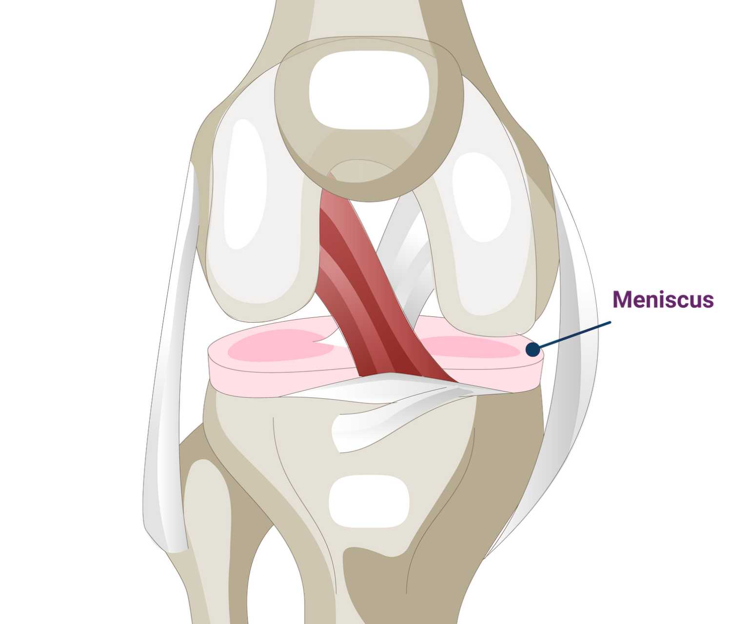 Meniscus Triangular Torn Meniscus - Dr. Chris Jones Colorado Springs, CO