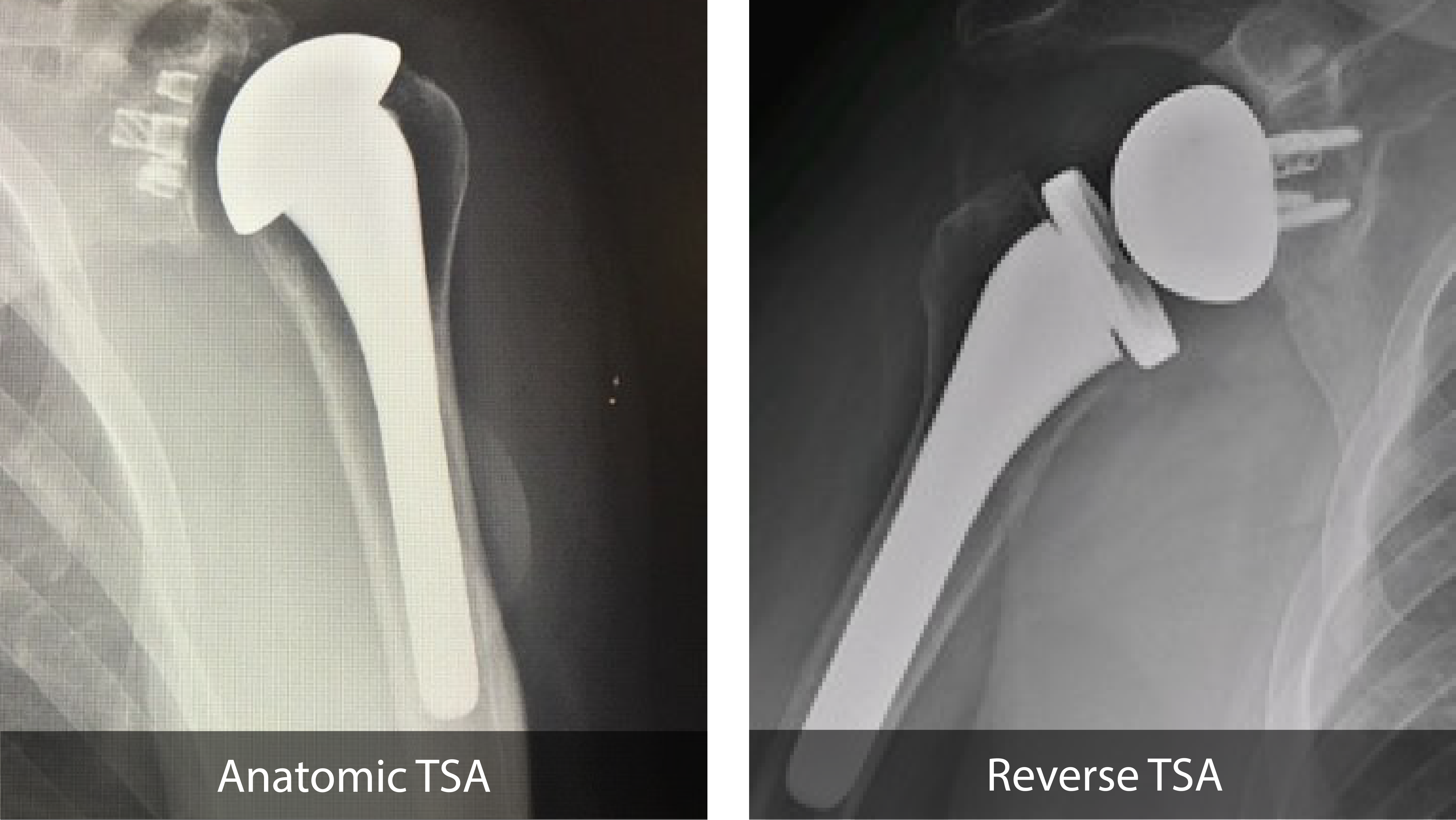 Reverse Shoulder Replacement Dr Chris Jones Colorado Springs CO