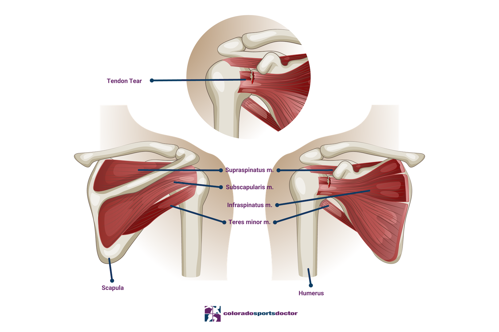 Rotator Cuff Tear Anatomy