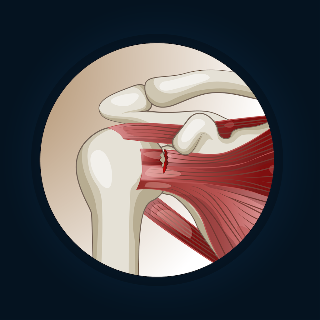 Colorado Springs Sports Doctor | Rotator Cuff Tear