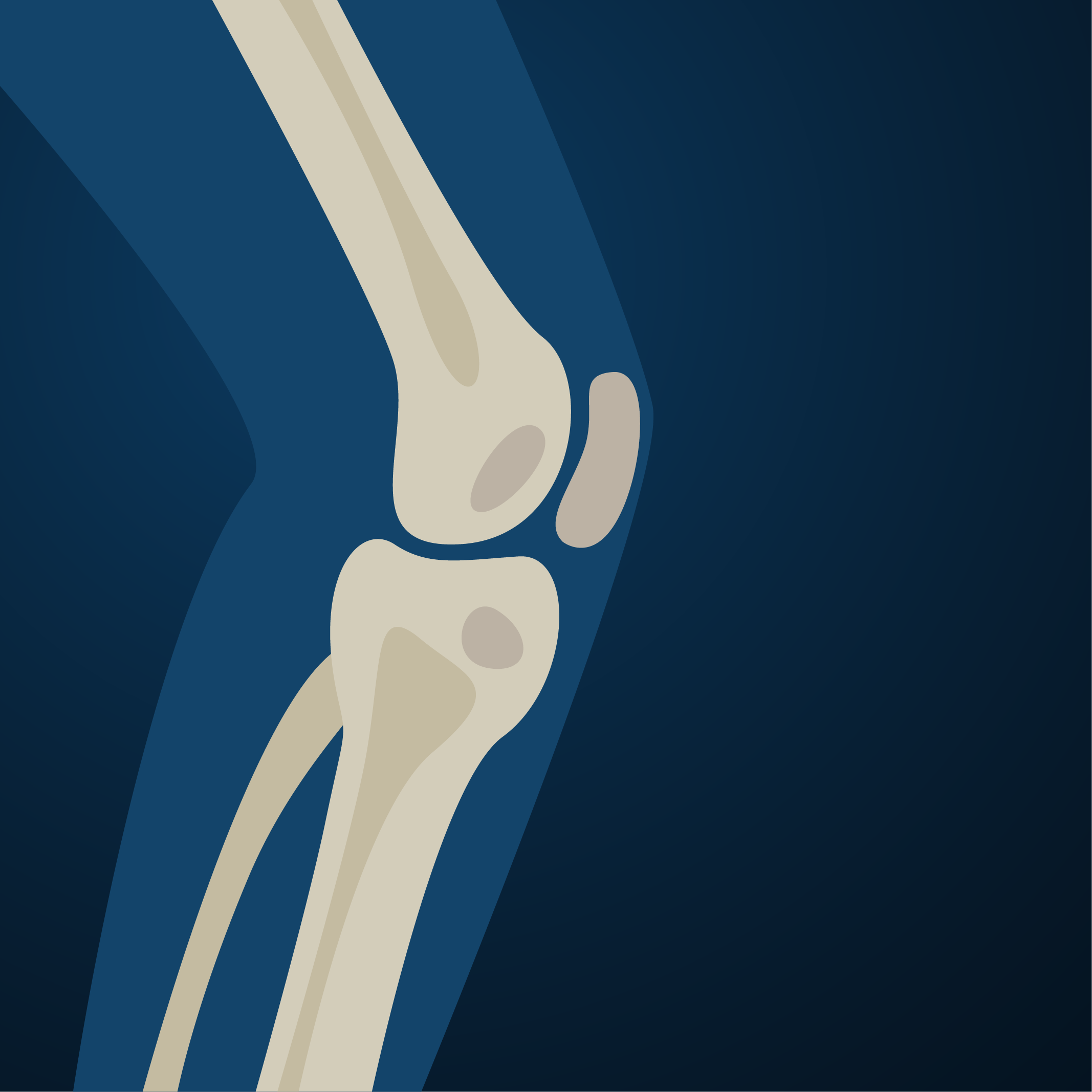 A torn meniscus is among the most common injuries that lead to an orthopedic evaluation for knee pain.