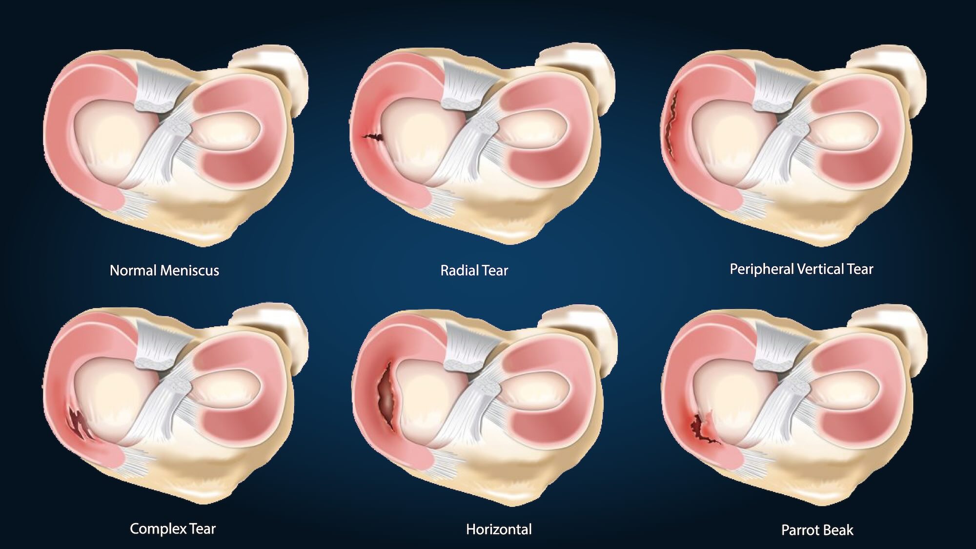 Tears of the menisci are a very common injury and cause of knee pain.