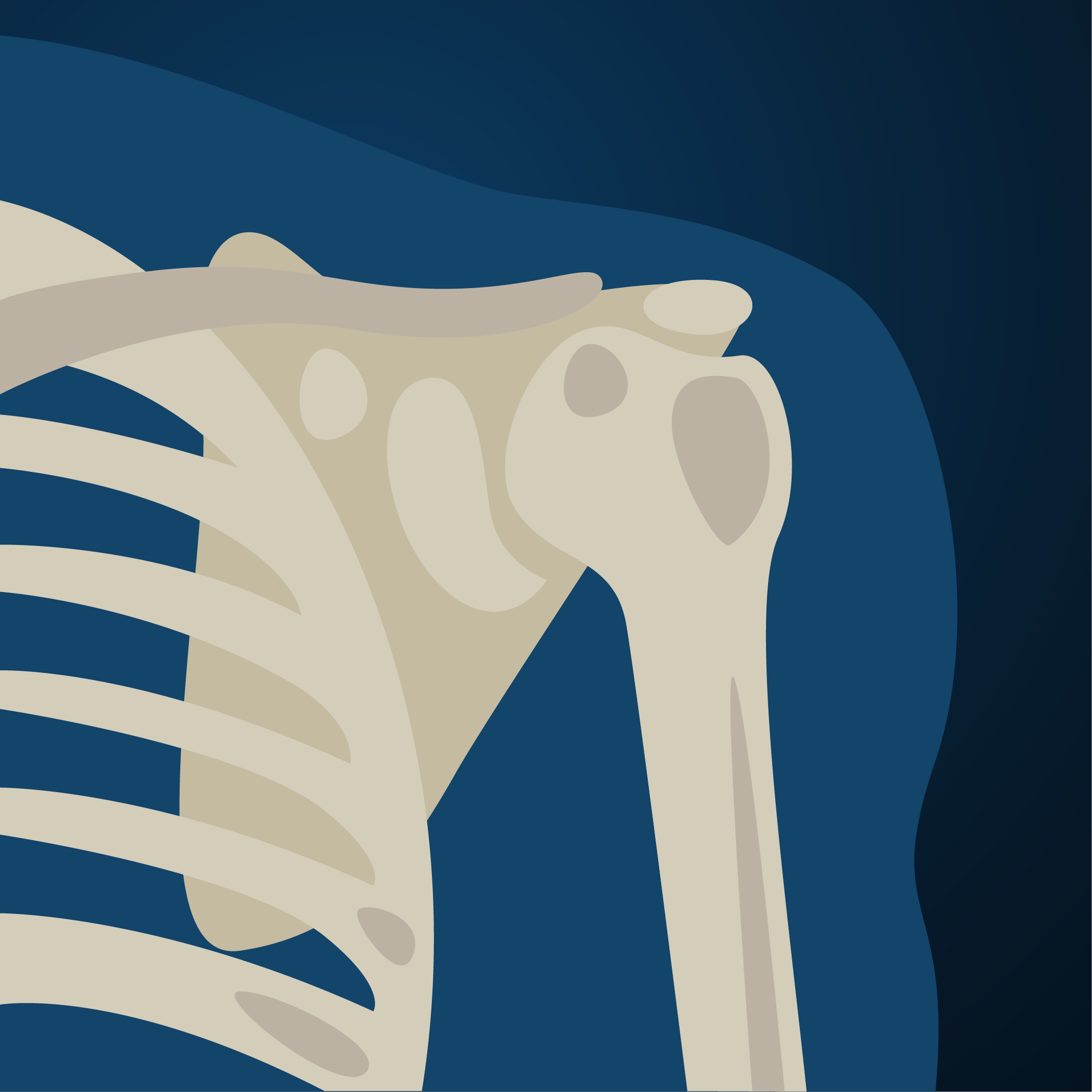 Shoulder replacement is the third most common joint replacement surgery with about 53,000 procedures done in the U.S. every year.